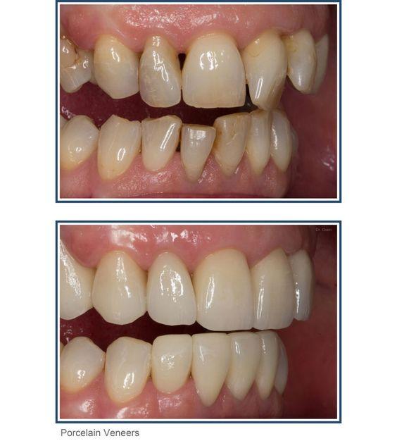 عکس کامپوزیت دندان