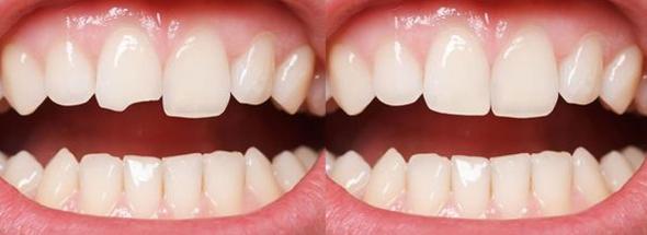 کامپوزیت دندان چگونه است
