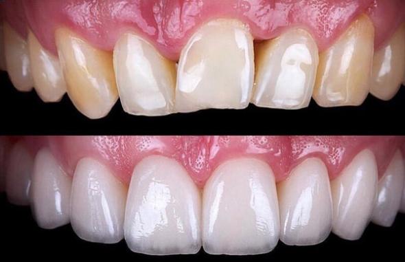 روکش تمام سرامیک