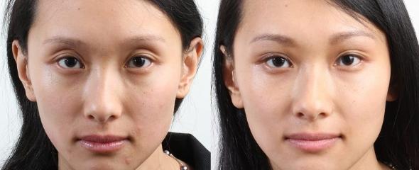 با انواع روشهای لیفت ابرو آشنا شوید لیفت آندوسکوپی ابرو