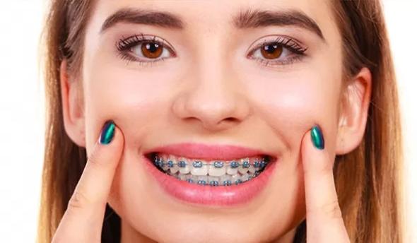 نکات مهم درباره ارتودنسی دندانها ارتودنسی ثابت