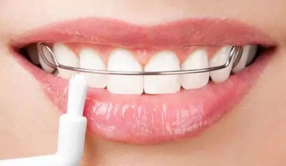 نکات مهم درباره ارتودنسی دندانها ارتودنسی متحرک