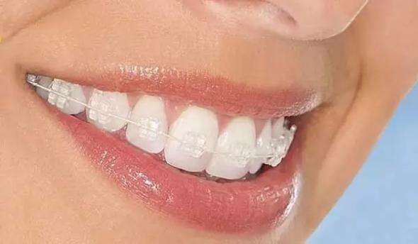 نکات مهم درباره ارتودنسی دندانها ارتودنسی با براکت های سرامیکی