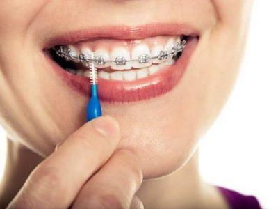 نکات مهم درباره ارتودنسی دندانها رعایت بهداشت ارتودنسی