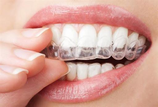 طول درمان و مدت زمان ارتودنسی دندان