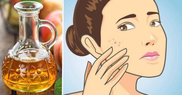 خواص سرکه سب برای پوست صورت