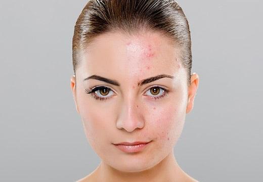 13 مدل ماسک صورت خانگی برای جوش که معجزه میکند درمان سریع جوش