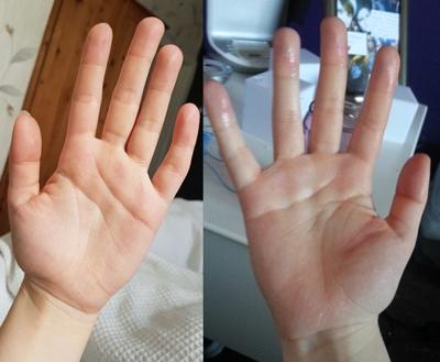 درمان قطعی عرق کف دست