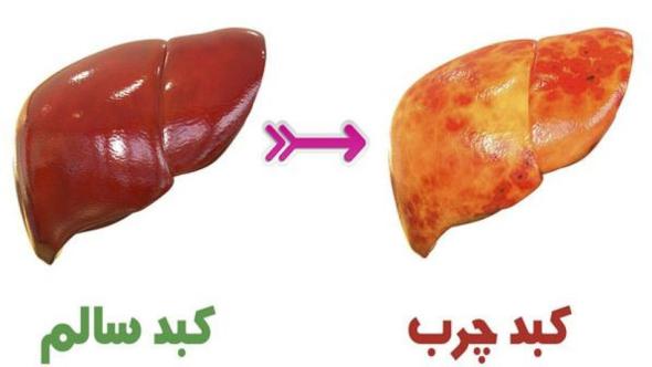 مبتلا به کبد چرب هستید؟ لیست بهترین غذاها برای درمان کبد چرب کبد چرب چیست