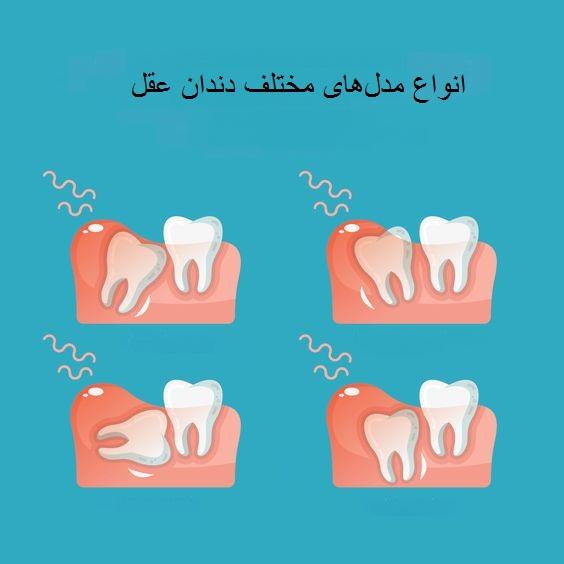 انواع دندان عقل درآوردن دندان عقل