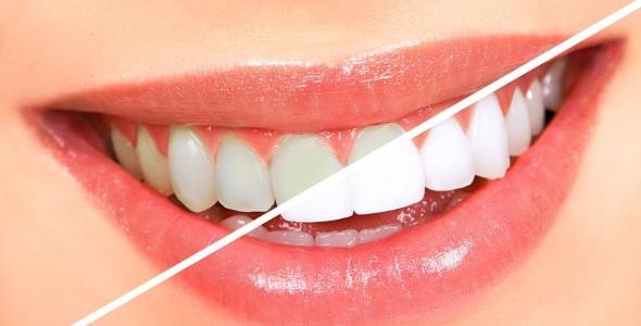 خمیر دندان سفید کننده