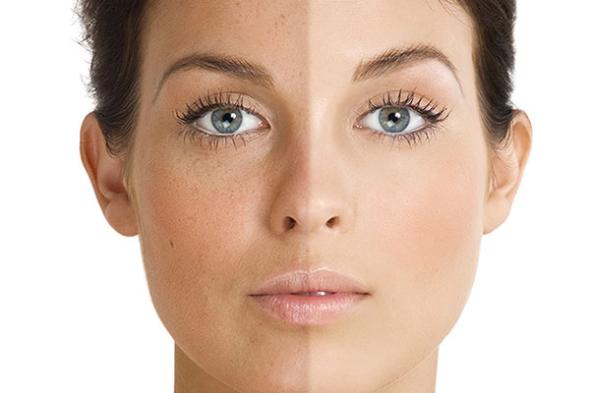 کرم ضدلک قوی کرم ضدلک قوی