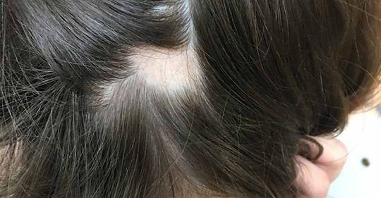 علت ناگهانی ریزش مو در زنان