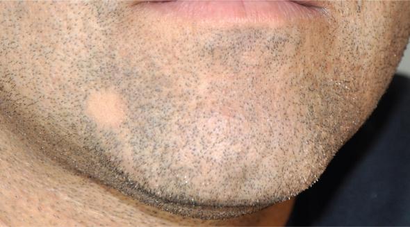 ریزش موی سکه ای در ریش چیست درمان ریزش موی سکهای ریش