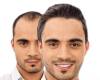 هرآنچه که آقایان درباره کاشت مو باید بدانند کاشت موی آقایان