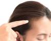 علت و درمان ریزش موی هورمونی در خانم ها