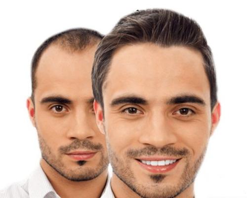 هرآنچه که آقایان درباره کاشت مو باید بدانند کاشت موی آقایان